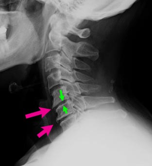 側面X線での骨棘と椎間板狭小化