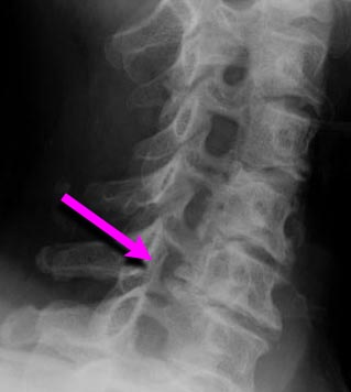 頚椎症のX線斜位像の椎間孔骨棘