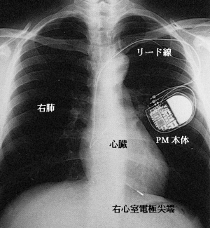 ペースメーカー植え込み患者の胸部レントゲン写真